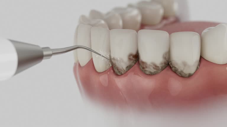 Reliable Wisdom Tooth Removal contractor in Spearfish, SD by Smile Center Dentistry